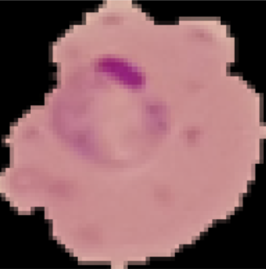 Microscopic blood smear image showing malaria-infected cells
